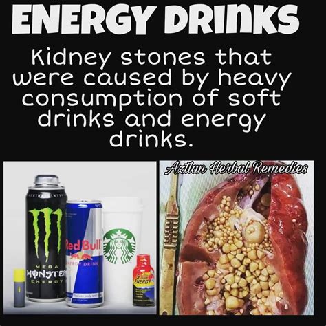 not drinking kidney stones.